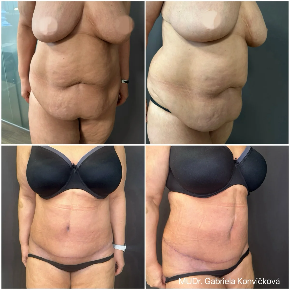 Abdominoplastika s liposukcí — před a po