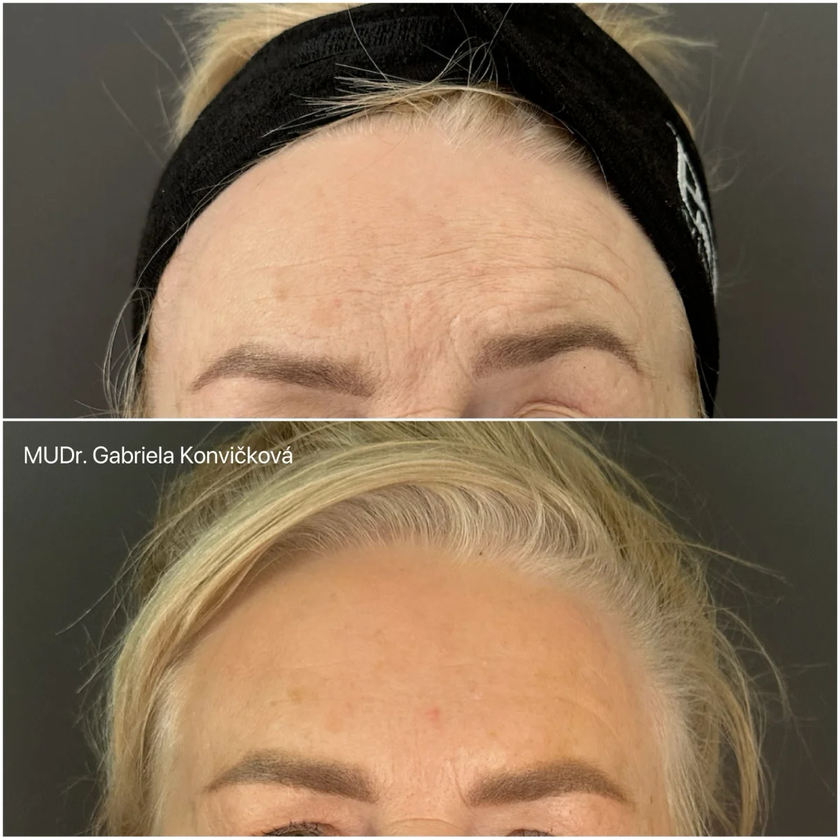 Botulotoxin — korekce asymetrie — před a po