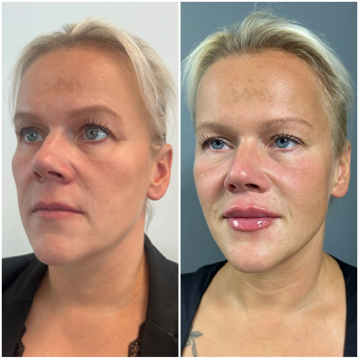 Lip lift + kyselina hyaluronová — před a po