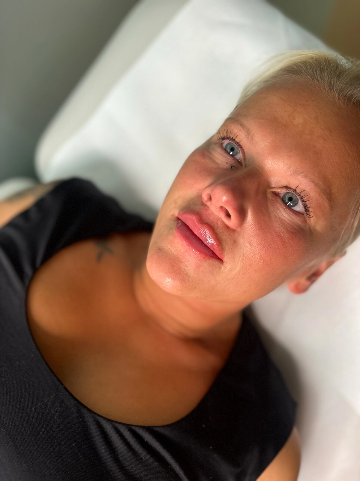 Lip lift + kyselina hyaluronová — před a po