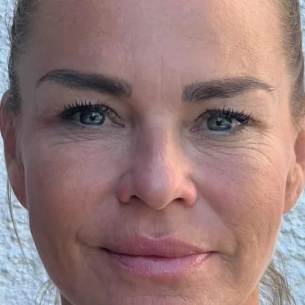 Botulotoxin a výplň — po zákroku