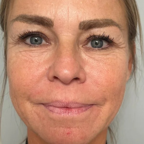 Botulotoxin a výplň — před zákrokem