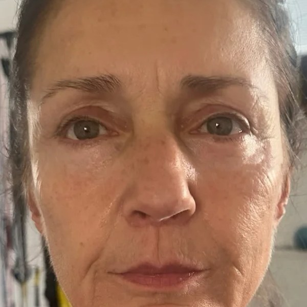 Dolní víčka + lip lift — po zákroku