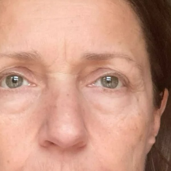 Dolní víčka + lip lift — před zákrokem