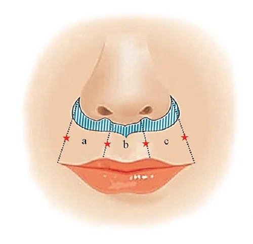 Ilustrace k zákroku