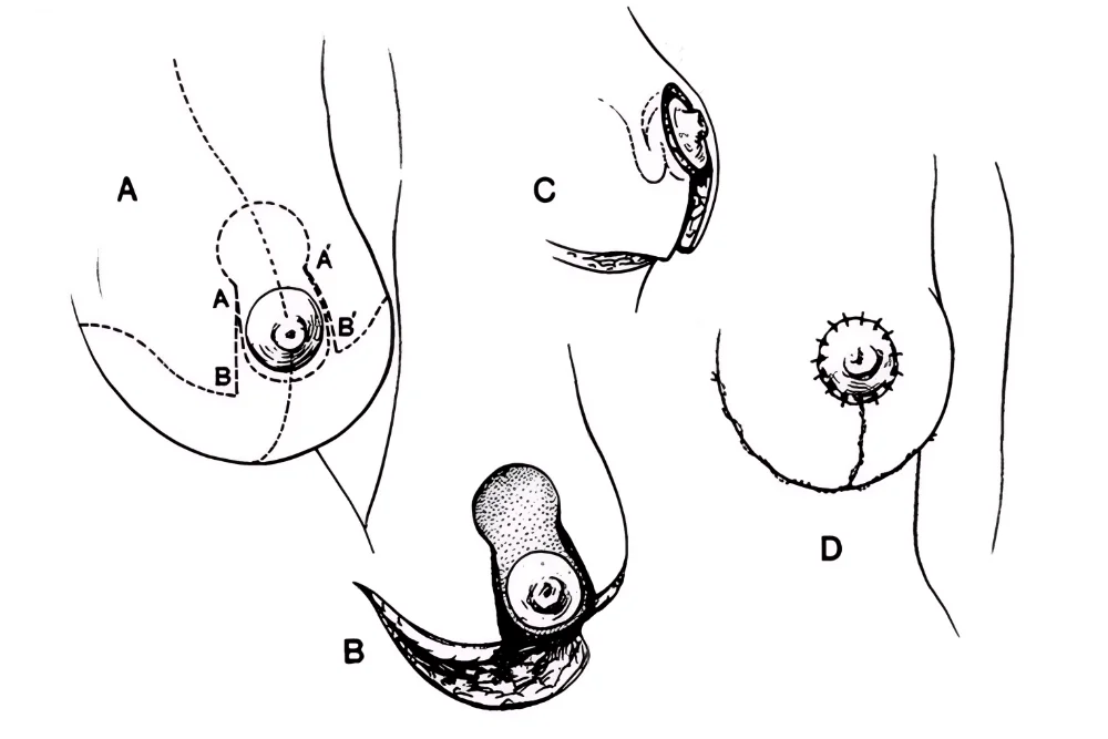 Ilustrace k zákroku